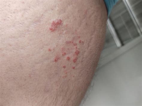 Can anyone identify this rash : r/medical