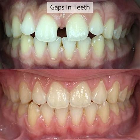 braces paddington invisalign teeth straightening   whites dental