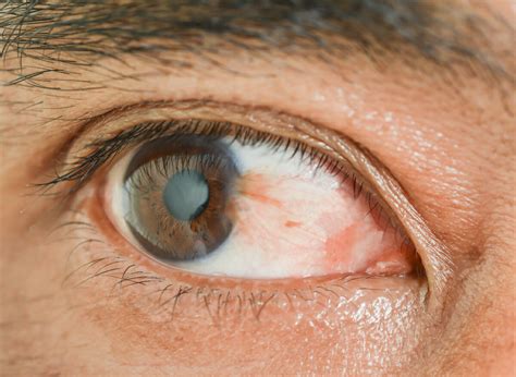 pterygium dr nathan kerr melbourne eye surgeon