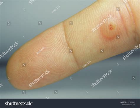 Viral Warts Cryotherapy Blisters On First库存照片1951883869 | Shutterstock
