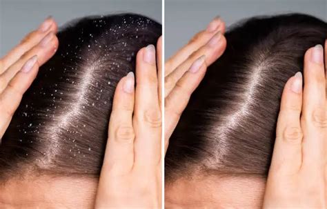 types  dandruff    prevent  hindi