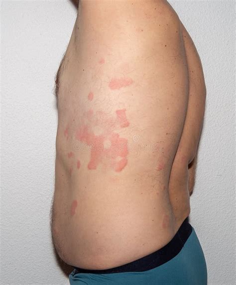 Allergy. Health. Reaction. Histamine. Intolerance Stock Image - Image ...