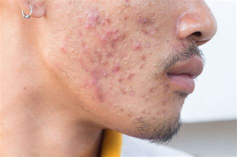 risk  bacterial resistance  systemic antibiotic   acne