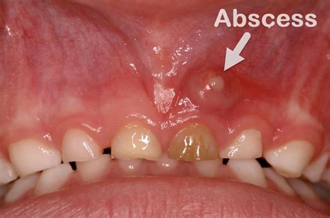 jaw abscess doctor explains dental abscess tooth abscess
