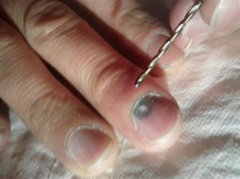 How to drain your subungual hematoma blood pocket under finger nail