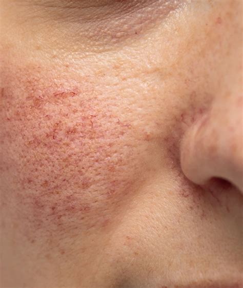 rosacea dr grace kelly aesthetics clinic buckinghamshire