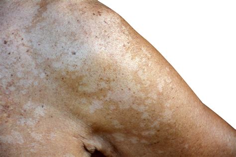 Do you have Malassezia? - Dr. William Davis