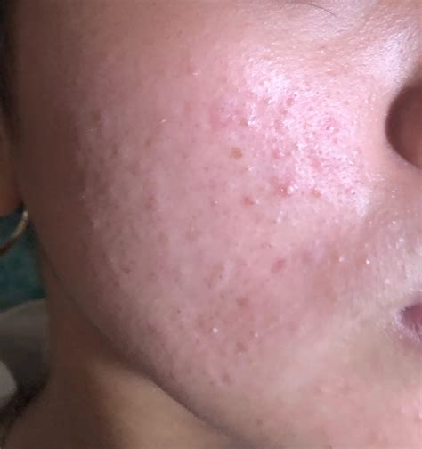 fungal acne? or allergy? : r/Fungalacne