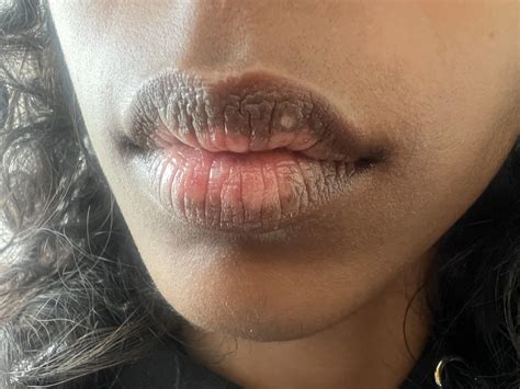 23 y/o f what is this white spot on my lip? very slightly raised, soft