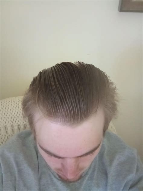 Receding or mature hairline : r/malehairadvice