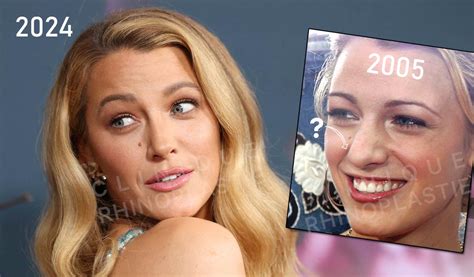 blake lively rinoplastica perche la rinoplastica  blake lively