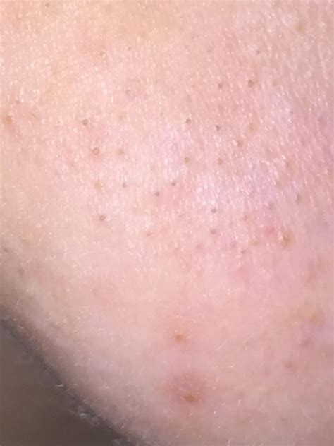 Shocking Truth About Unbelievable Blackhead Removal 2024 Revealed! Image 18