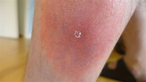 common bug bites      identify  artofit