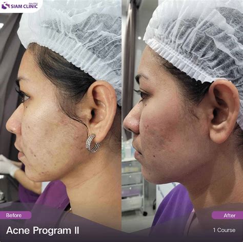 Review Acne Treatment Обзор кейсов Лечение акне - Siam Clinic Phuket ...