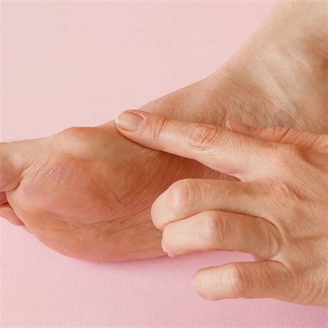 How Do I Know If I Have a Bunion? - Victoria Foot & Ankle Center