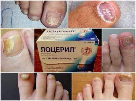 Ефективні засоби від грибка нігтів на ногах народні, найдешевші в ...