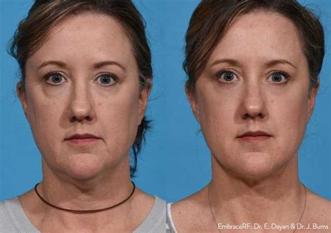 FaceTITE BodyTITE Morpheus8 Before-After Pics - ReGen Medical Clinic