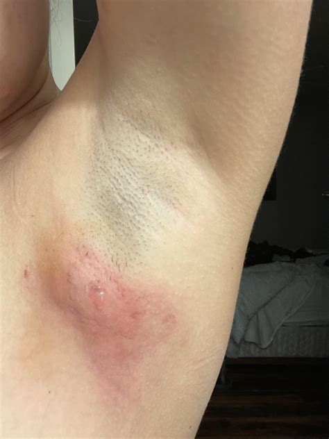Abscess Drainage Arm
