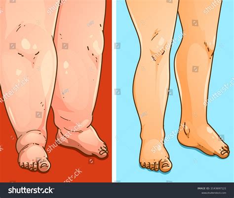 Edema Legs Before After Medical Illustration Stock Vector (Royalty Free) 2143697121 | Shutterstock