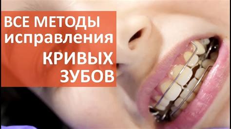 Кривые зубы что делать. 😁 Как сделать выбор метода исправления кривых ...
