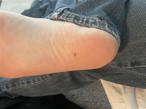 Spot of bottom of foot : r/Melanoma