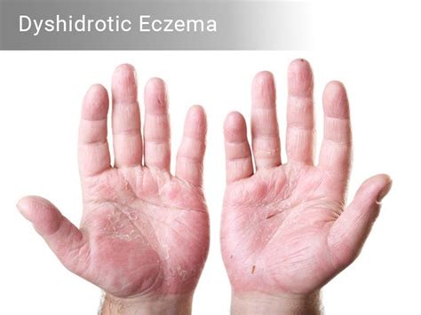 Read more to know What is Dyshidrotic Eczema, its causes, symptoms. In this article you can ...