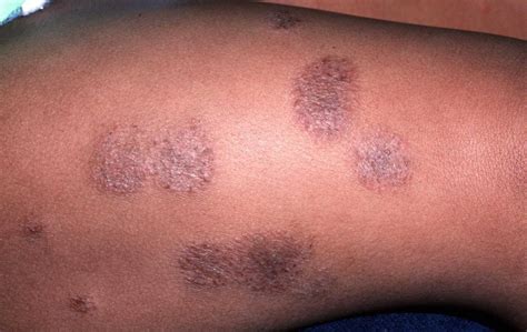 dermatitis - HealthFacts NG