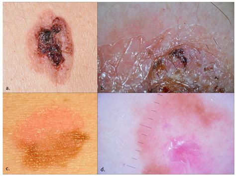 Bowens Disease