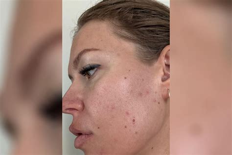 Рита Дакота показала проблемы с кожей на фоне разборок с косметологом ...