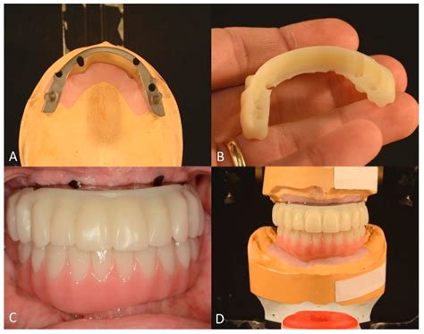 Full-Mouth Rehabilitation of a Patient with Sjogren’s Syndrome with
