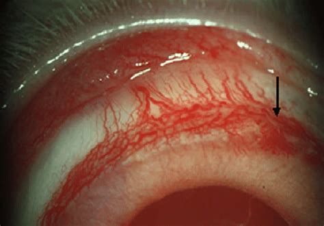 Corneal neovascularization formation after removing the sutures ...