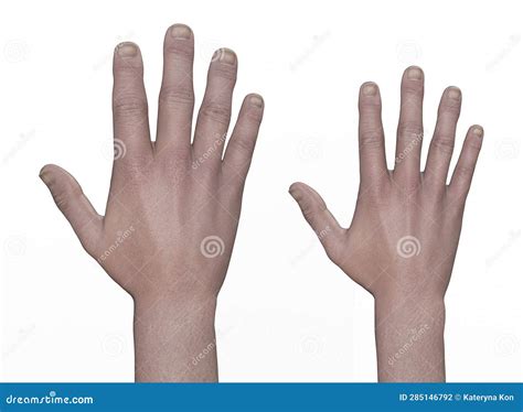Hand with Acromegaly and the Same Healthy Hand, 3D Illustration Stock ...