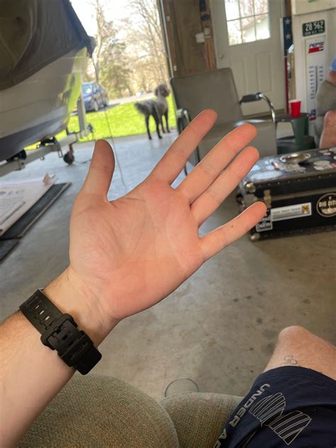 Palmar erythema? : r/medical_advice