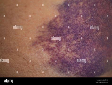Buttock injury hi-res stock photography and images - Alamy