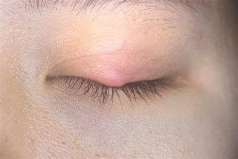 Orbital Cellulitis: A Serious Eye Infection Explained