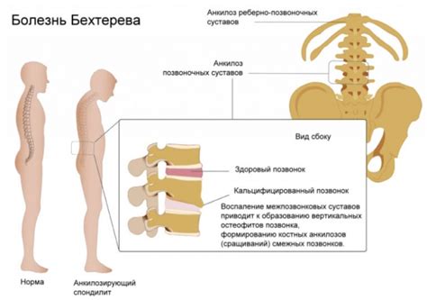 Анкилозирующий спондилоартрит (болезнь Бехтерева) | Med & Care