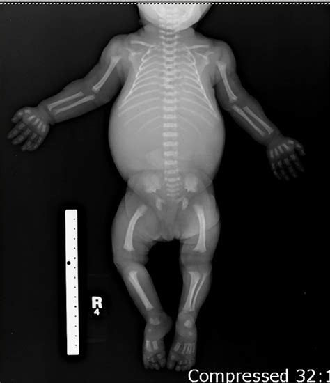 In The Term Achondroplasia The Suffix Means
