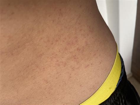 Itchy rash appeared on my rib cage/torso/back and now pelvis : r