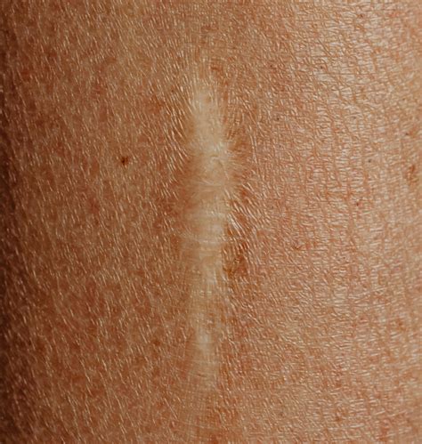Scar Treatment - The Dermatology Clinic London
