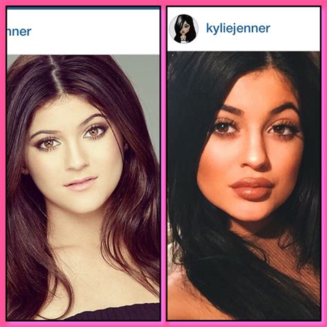 Before and after of Kylie Jenner. | Kylie jenner plastic surgery