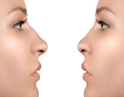 rhinoplasty projects   logos illustrations