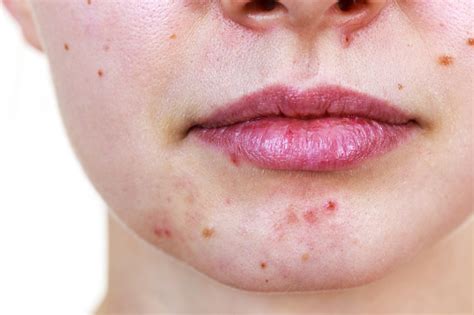 550+ Face With Pimples Pictures | Download Free Images on Unsplash