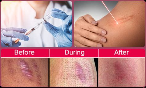 Keloids - Dr Sajjas Clinic in Tirupati