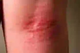 Flexural Eczema: Symptoms, Causes, and Treatments