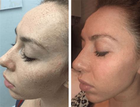 Sunspots On Face Treatment