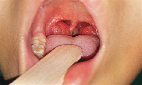 Tonsillitis symptoms: Signs of virus infection include white spots in ...