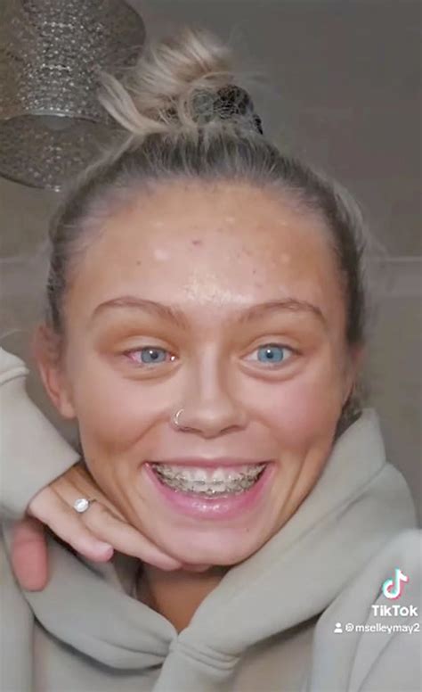 Model trolled for 'lazy' eye transforms after undergoing corrective