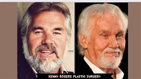 Kenny Rogers Botox And Nose Job - Before And After Surgery