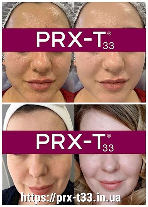 Пілінг PRX-T33 до і після - prx-t33.in.ua