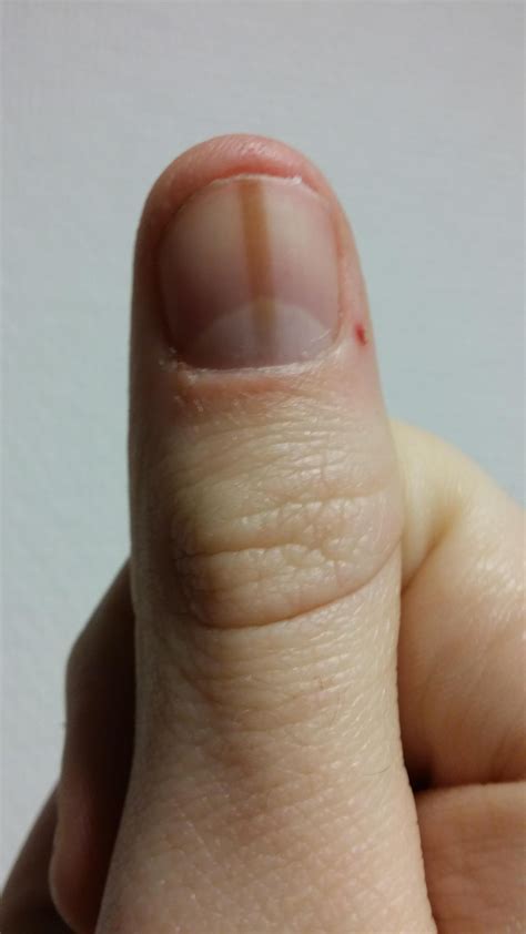 My thumbnail has a brown spot which grows with the nail. I've had it my